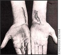 Gerard McLaverty's wrist wounds